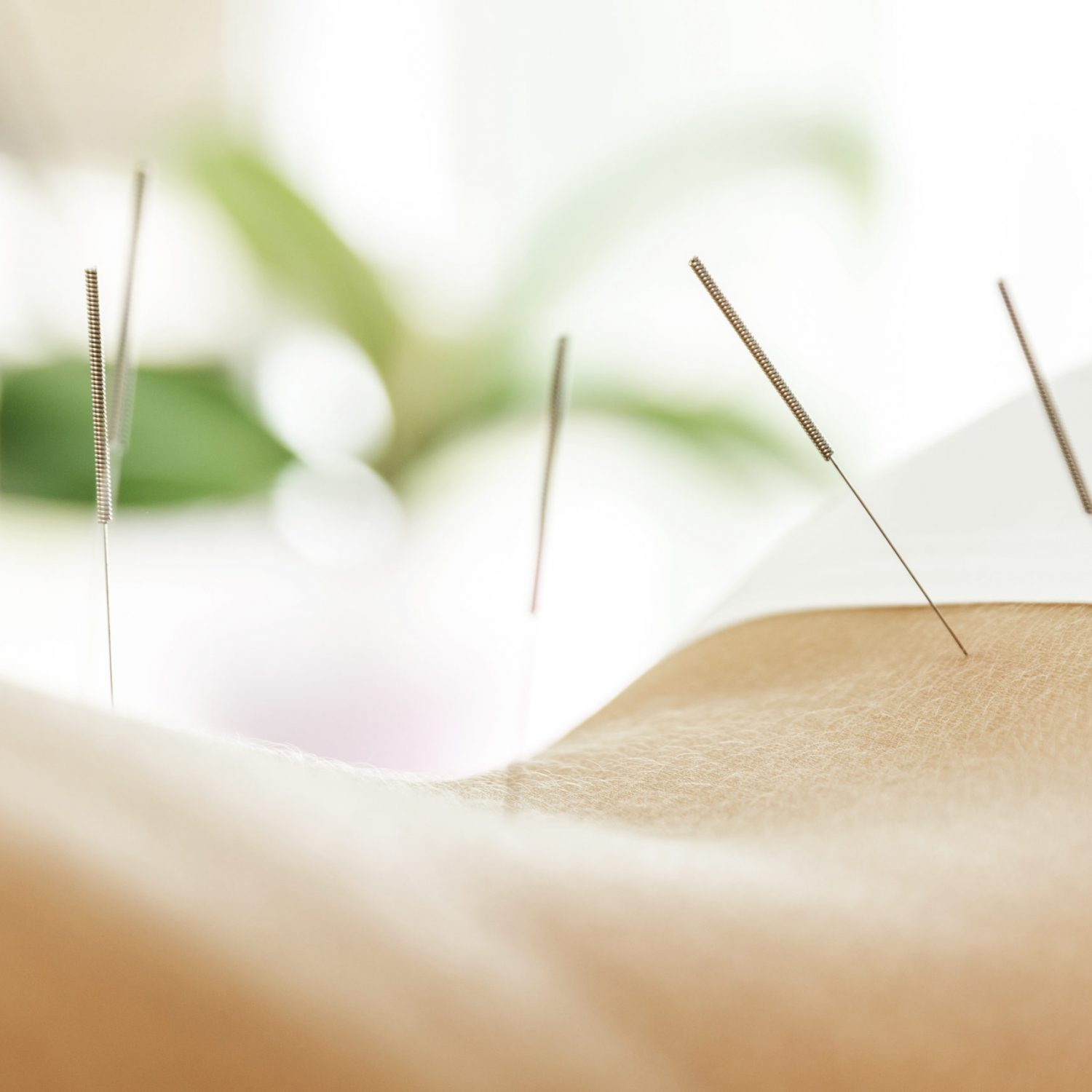 Alternative medicine. Close-up of female back with steel needles during procedure of acupuncture therapy.